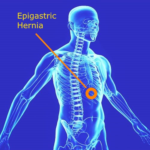 Epigastric hernia repair (adult)